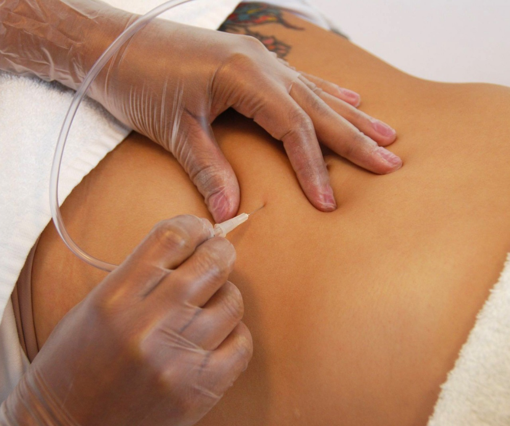 CARBOXITERAPIA
