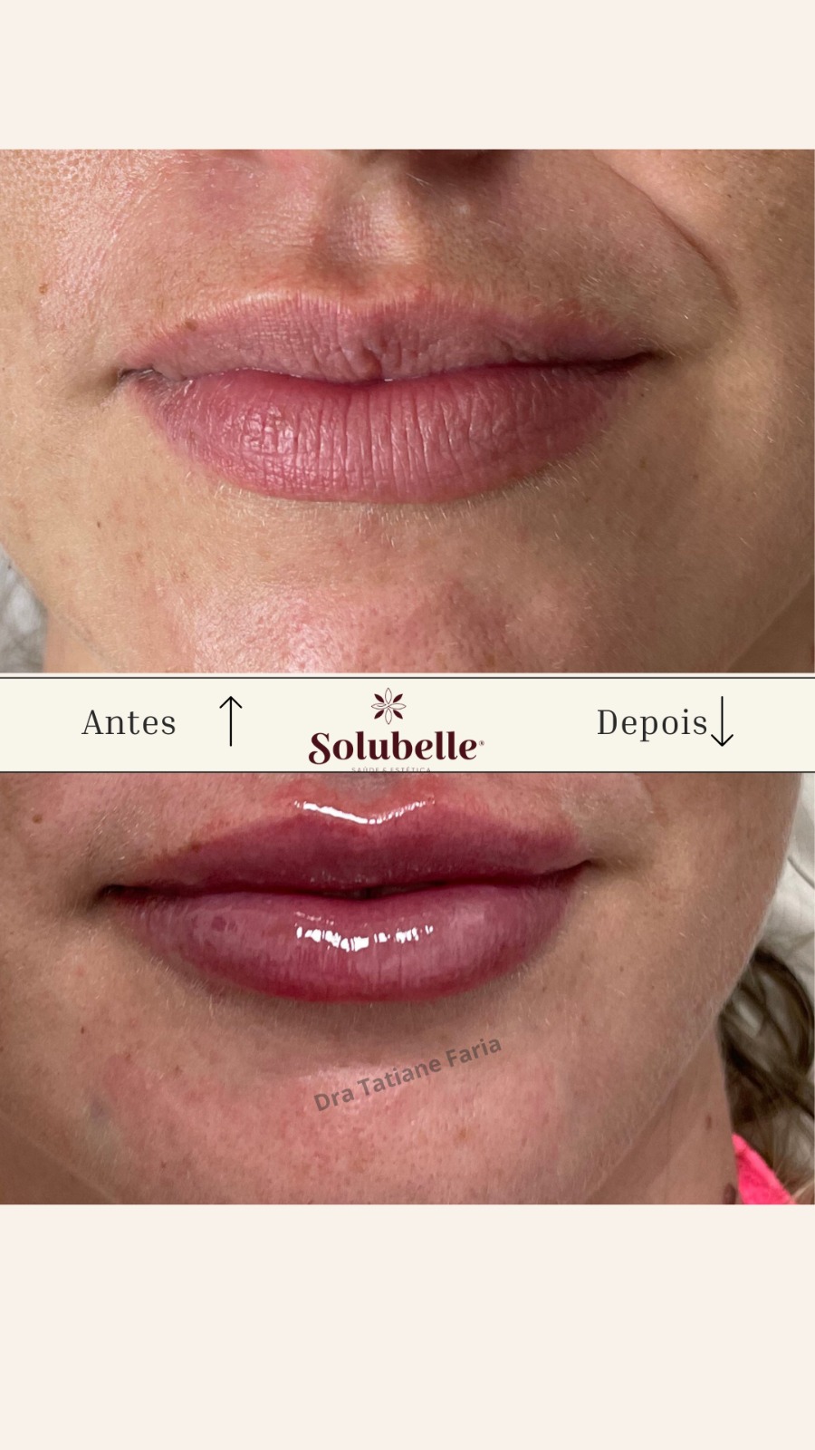 PREENCHIMENTO LABIAL