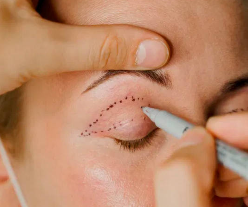 BLEFAROPLASTIA SEM CORTE